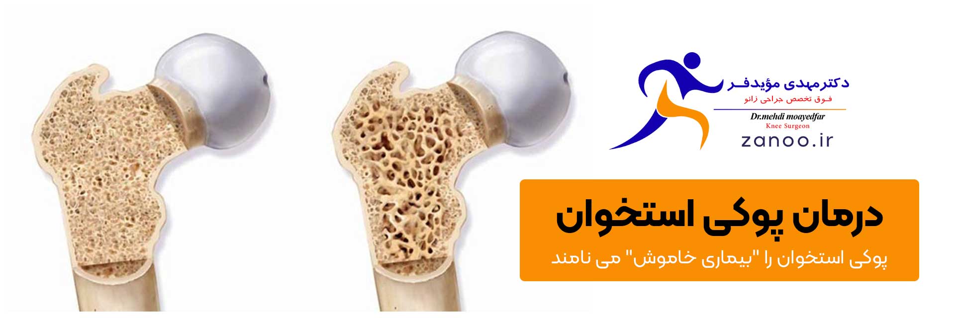 Osteoporosis، درمان پوکی استخوان در اصفهان،  نام دیگر پوکی استخوان بیماری خاموش است، بهترین دکتر جراحی رباط صلیبی زانو در اصفهان، دکتر مویدفر جراح زانو در اصفهان