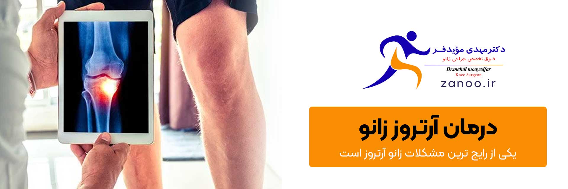 knee-arthritis، درمان آرتروز زانو در اصفهان، بهترین دکتر تعویض مفصل زانو اصفهان، دکتر خوب زانو در اصفهان