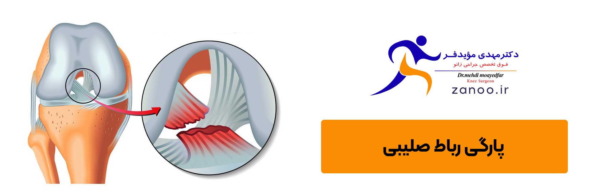 پارگی مینیسک زانو, آسیب زانو در ورزش قفل شدگی زانو, پارگی مینیسک زانو, آسیب زانو در ورزش, فوق تخصص زانو در اصفهان, درد بسیار شدید زانو, جراحی آرتروسکوپی زانو اصفهان, بهترین جراح زانو در اصفهان, درمان پارگی مینیسک زانو, پارگی رباط صلیبی ACL