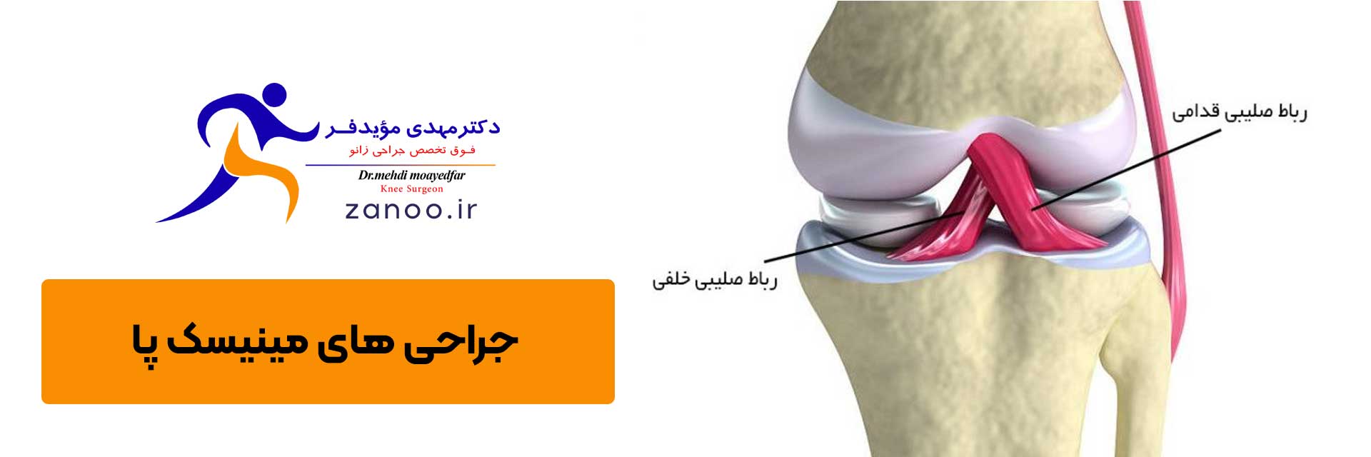 جراحی آرتروسکوپی زانو اصفهان قفل شدگی زانو, پارگی مینیسک زانو, آسیب زانو در ورزش, فوق تخصص زانو در اصفهان, درد بسیار شدید زانو, جراحی آرتروسکوپی زانو اصفهان, بهترین جراح زانو در اصفهان, درمان پارگی مینیسک زانو, پارگی رباط صلیبی ACL
