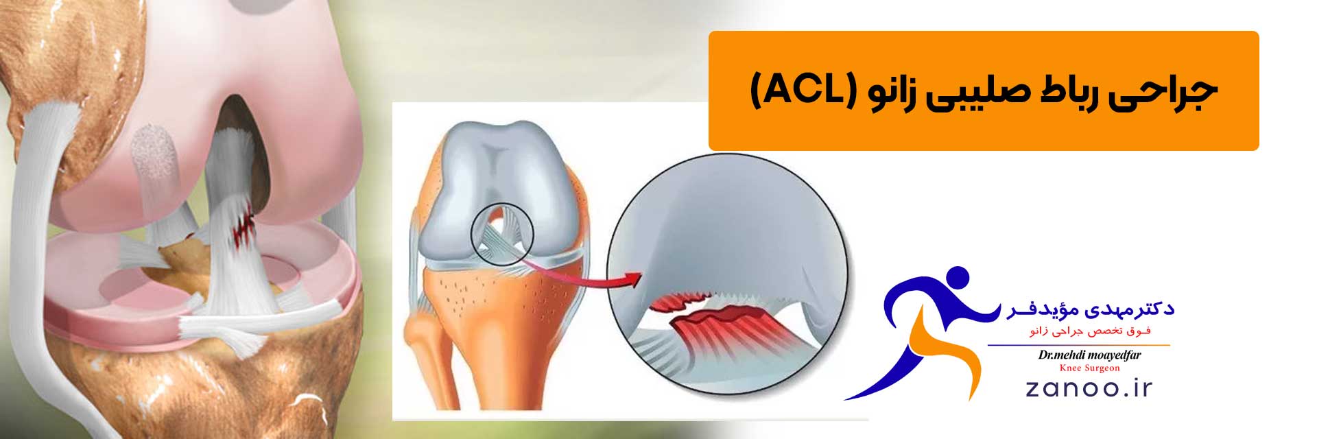 راه-های-تشخیص-آسیب-ACL